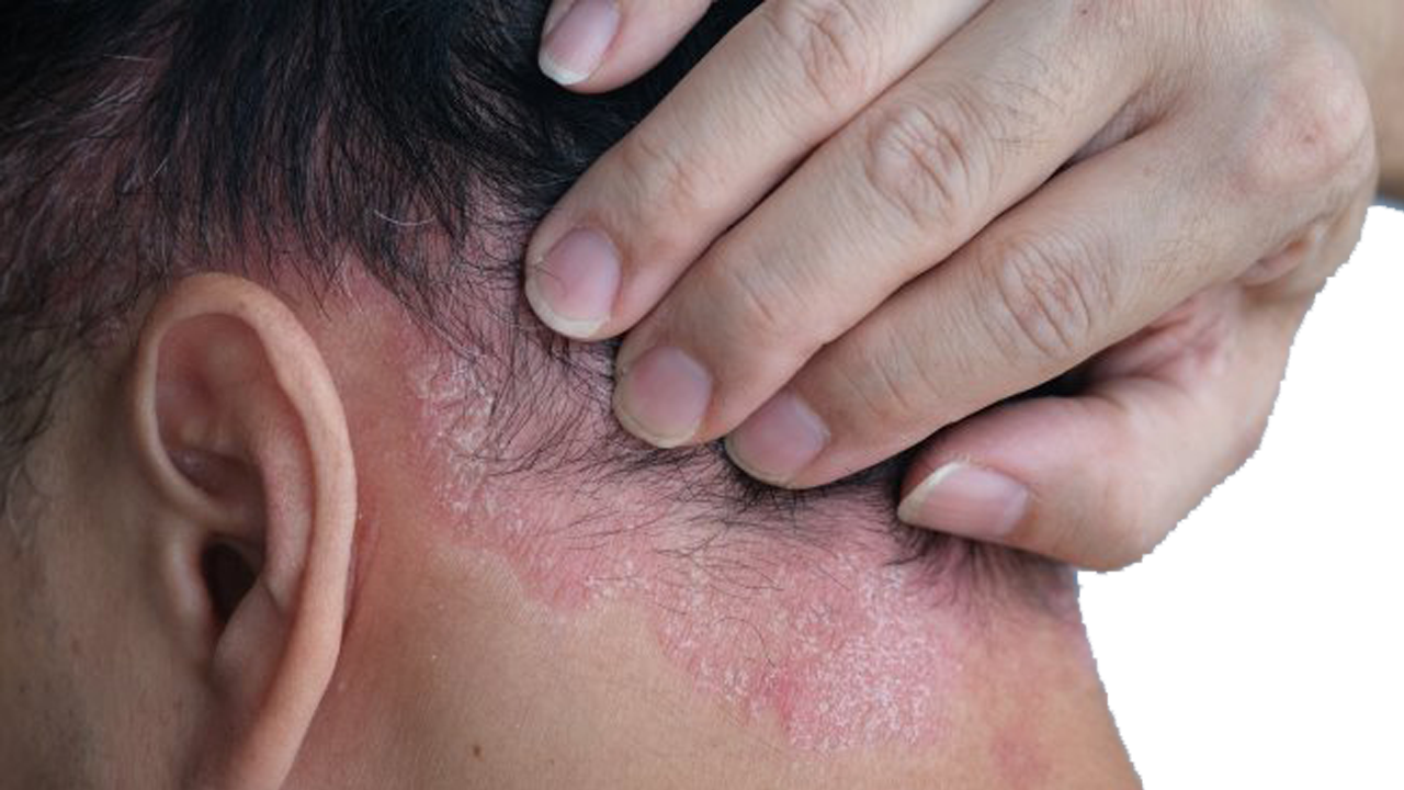 Seborrheic Dermatitis
