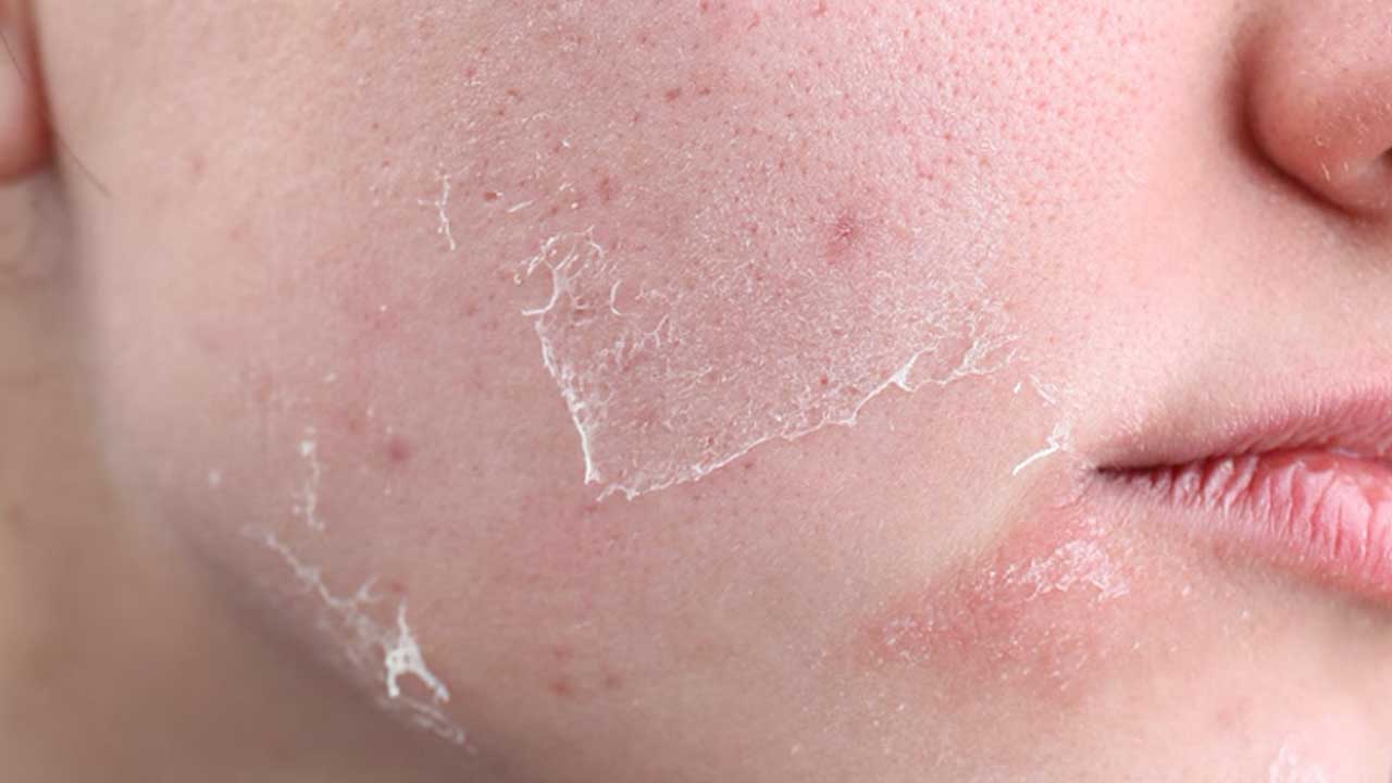 Dry Skin