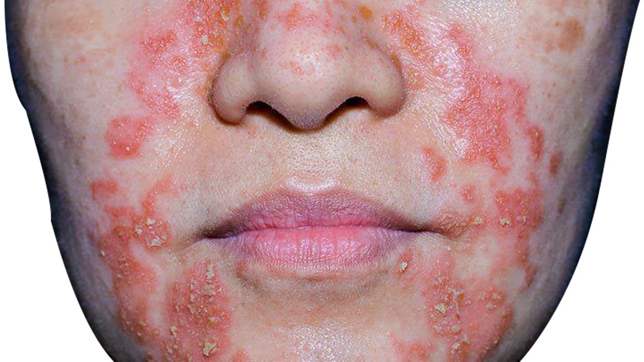 Eczema