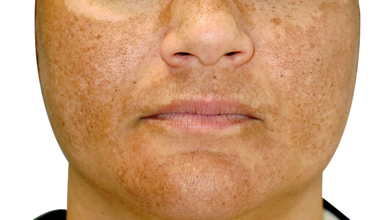 Hyperpigmentation