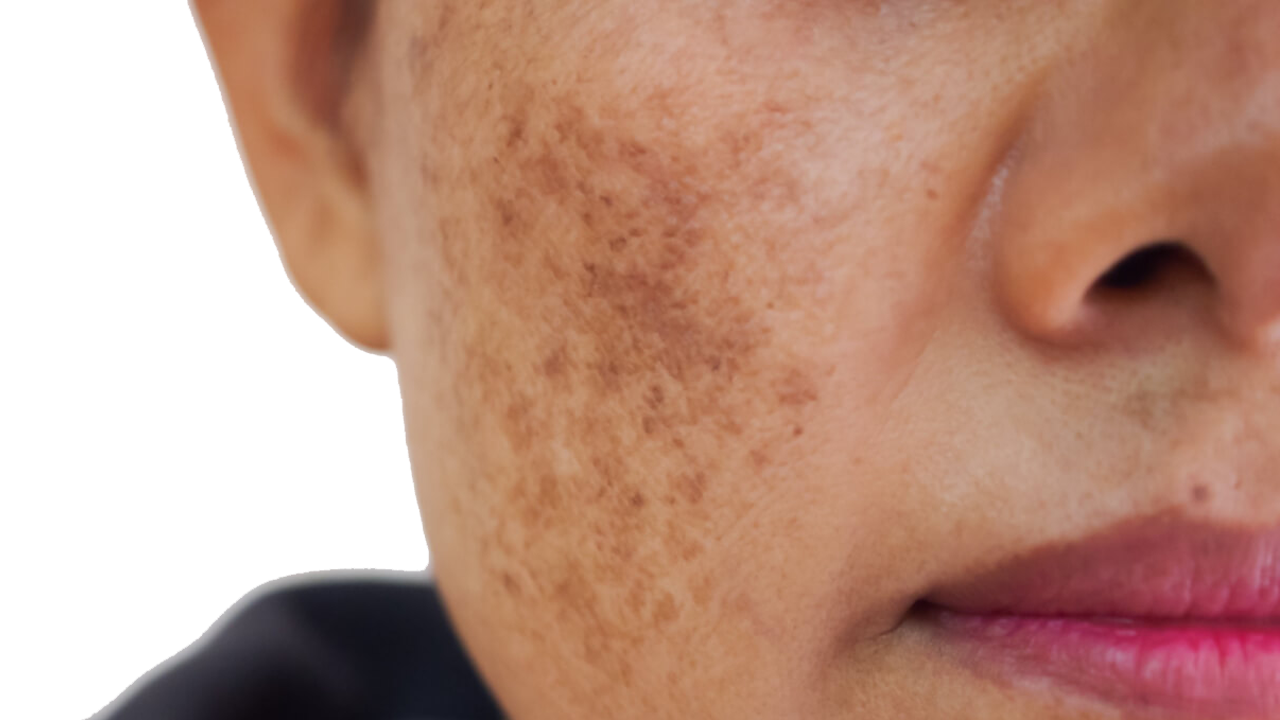 Melasma