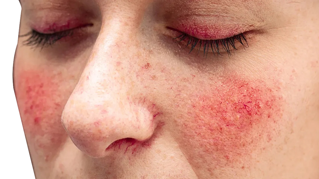 Rosacea