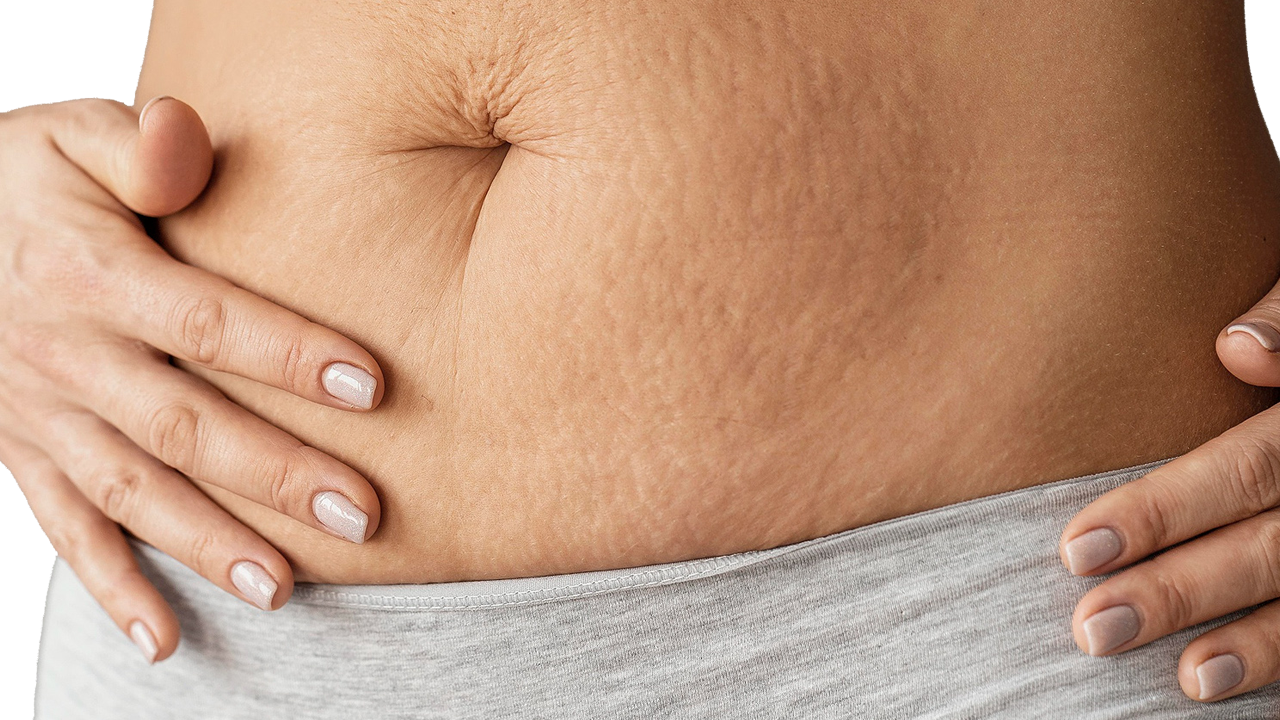 STRETCHMARK
