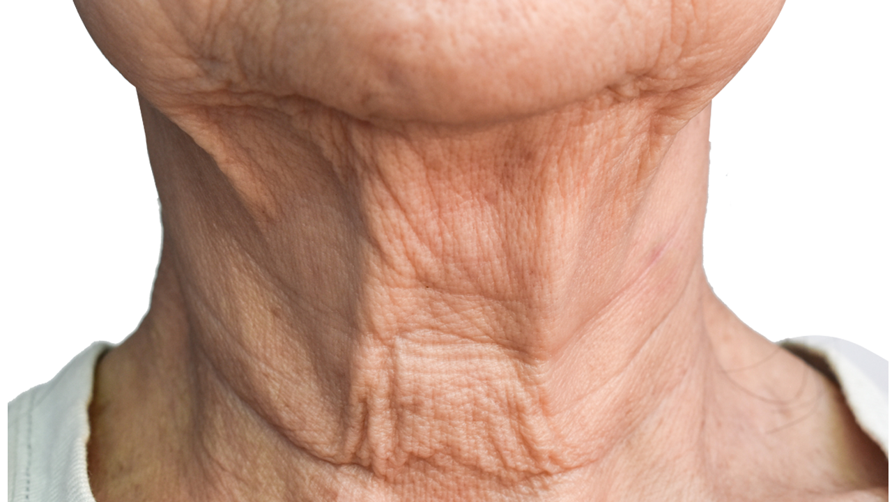 Sagging Neck Area