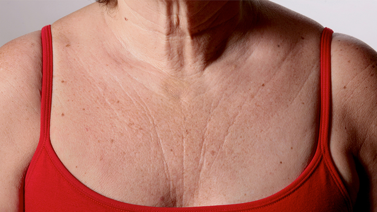 Wrinkle and Aging Chest Area