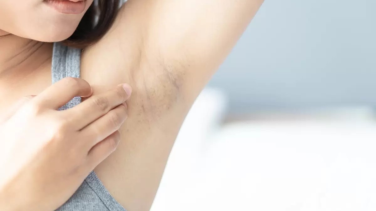 HYPERPIGMENTATION UNDERARM